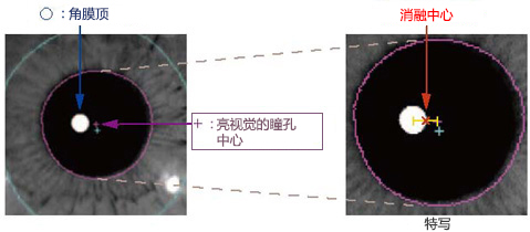 Eye Tracking Offset to move ablation center Eye Tracking Offset to move ablation center